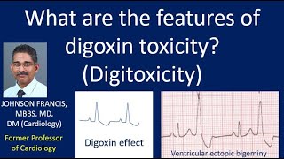 What are the features of digoxin toxicity Digitoxicity [upl. by Anead852]