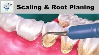 Dental Scaling and Root Planing  Treatment of Gum Disease [upl. by Campos]