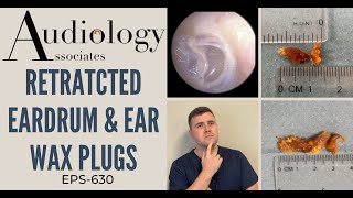 RETRACTED EARDRUM amp EAR WAX PLUGS  EP630 [upl. by Larrad]