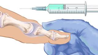 First Metatarsophalangeal Joint Injection [upl. by Marriott]