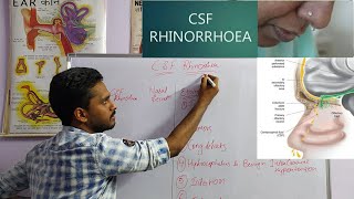 CSF RHINORRHEA  ENTNOSE [upl. by Atnas]