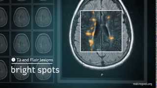 Multiple Sclerosis Understanding Your MRI [upl. by Lodovico]