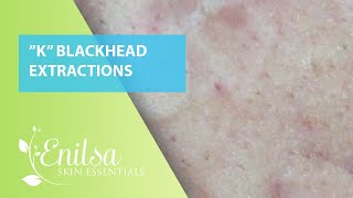 Blackheads Extractions “K’s” 6th Treatment [upl. by Marala]