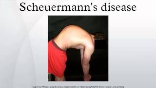 Scheuermanns disease [upl. by Mitran]