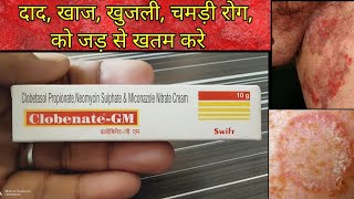 Clobenate GM cream uses side effectsfull review दाद खाज खुजली चमड़ी की लालिमा चमड़ी rog हिन्द [upl. by Stu]