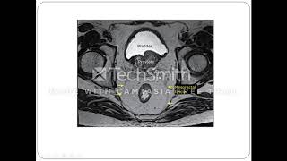 MRI Evaluation of Carcinoma of Rectum [upl. by Hyacinthe937]