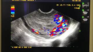 Arteriovenous malformation AVM Uterus in Retained products of conception [upl. by Surbeck839]