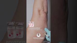 Ліполітична корекція внутрішньої поверхні рук Dermaheal LL 🟠💉ліполітик мезотерапія [upl. by Neal635]