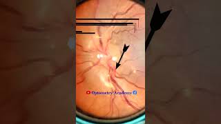 Tortuous Retinal vessels  Fundus Photography  Short Video 109 optometry optometrist [upl. by Adekram902]