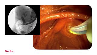 Dr Sam Serouya Performs amp Narrates a Sphincterotomy and Stent Placement Using the aScope™ Duodeno [upl. by Carley840]