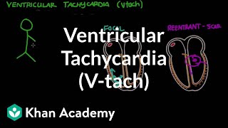 Ventricular tachycardia Vtach  Circulatory System and Disease  NCLEXRN  Khan Academy [upl. by Yelbmik]