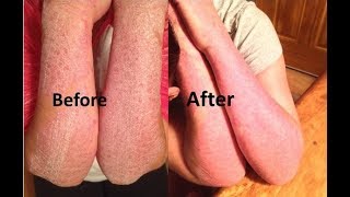 Have you healed your Eczema  Psoriasis  Dermatitis [upl. by Anitnelav]