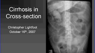 CT of liver cirrhosis  HD Basic Radiology [upl. by Ahsemed]