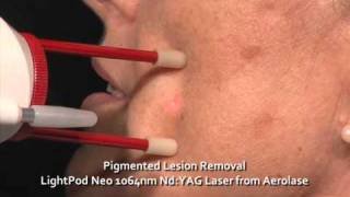 Pigmented Lesion Removal  The LightPod Neo 1064nm Laser by Aerolase [upl. by Della848]