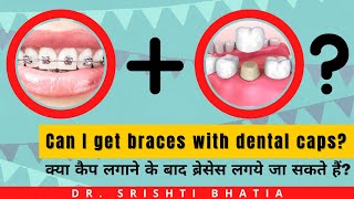 Can I get braces with dental caps or implants Dr Srishti Bhatia [upl. by Naryk854]