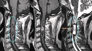 Spinal Masses  Location Intramedullary Ependymoma [upl. by Akirahc]