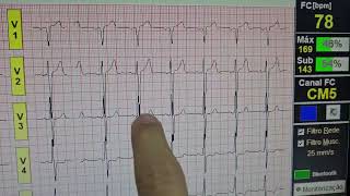 alterações da repolarização ventricular em paredes do coração ao ECG [upl. by Romina]