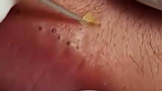 The Most Painful Blackhead Removal Video on Lips 2024 [upl. by Suixela]