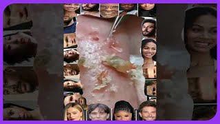 Satisfying Blackhead Removal Popping Pimples and Blackheads on Skin  2024 [upl. by Sancho]