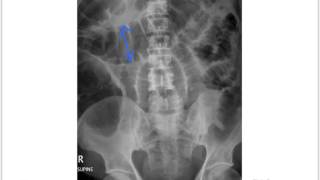 Small bowel obstruction [upl. by Varien]