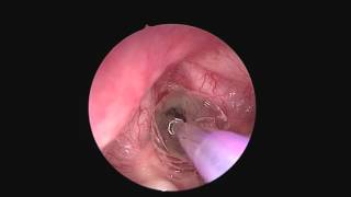 Subglottic Stenosis and Balloon Dilation [upl. by Aneryc]