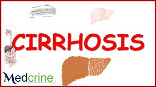 LIVER CIRRHOSIS causespathophysiologyfeaturesdiagnosistreatment [upl. by Ennairek]