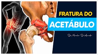 TUDO O QUE VOCÊ PRECISA SABER SOBRE FRATURA DO ACETÁBULO  TRATAMENTO E RECUPERAÇÃO [upl. by Larianna810]