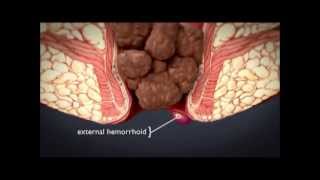 HEMORRHOiDS  What are hemorrhoids  What is the treatment for hemorrhoids [upl. by Auric]