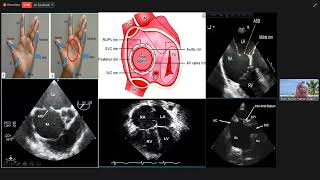 ASD Echo Evaluation [upl. by Anelrats]