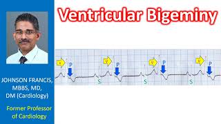 Ventricular Bigeminy [upl. by Ecikram813]