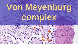 What are Von Meyenburg Complexes  Pathology mini tutorials [upl. by O'Kelly]