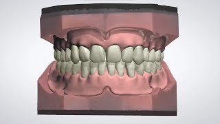 3Shape Dental System  Full Denture Design [upl. by Jasmine804]