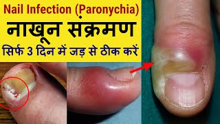 Nail Infection Paronychia  Cause amp Treatment  नाखून संक्रमण का इलाज कैसे करें [upl. by Adlin]