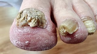 PEDICURE TRANSFORMATION Cleaning and cutting toenail [upl. by Syla]