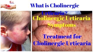 What is Cholinergic Urticaria  Cholinergic Urticaria Symptoms Treatment for Cholinergic Urticaria [upl. by Enovi]