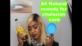 All Natural home remedy for getting rid of chalazion in just 3 days  Thank me later [upl. by Hakim]