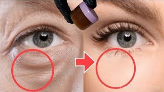 How to remove wrinkles around the eyes sagging eyelids circles and bags under the eyes [upl. by Atirys]