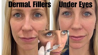 Dermal Filler Under Eyes Restylane [upl. by Stafani122]