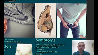 Testicular Cancer Symptoms causes and treatment [upl. by Adyht]