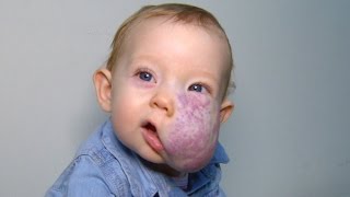 See 2YearOlds Incredible Transformation After Surgery To Remove Facial Tumor [upl. by Eidok]