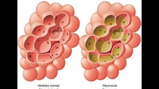 Neumonia  Fisiopatológia  Cuadro Clinico [upl. by Norramic]