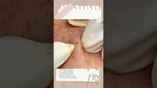 Big Cystic Acne Blackheads Extraction Blackheads amp Milia Whiteheads Removal Pimple Popping shorts [upl. by Dulci991]