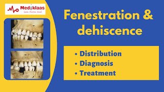 Fenestration and Dehiscence l Periodontal anatomy l Mediklaas [upl. by Matazzoni]