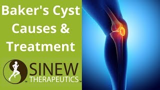 Bakers Cyst Causes and Treatment [upl. by Nash]