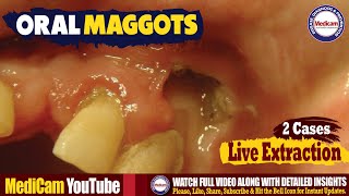 Oral Maggots Myiasis Infestation  Causes and Extraction [upl. by Roshelle182]