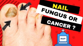 Subungual Melanoma  Deadly Form of Nail Cancer or Fungal Nail Infection [upl. by Atig742]