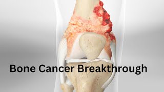 Bone Cancer Breakthrough [upl. by Tjader]