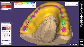 Diseño de Guarda Oclusal Nocturna  EXOCAD [upl. by Aehsa]