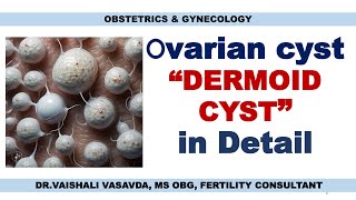 DERMOID CYSTS IN THE OVARY  DRVAISHALI VASAVDA [upl. by Lurette]