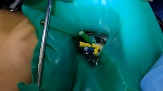 Endodoncia en un Primer molar superior derecho Pz 16 [upl. by Airdnoed]